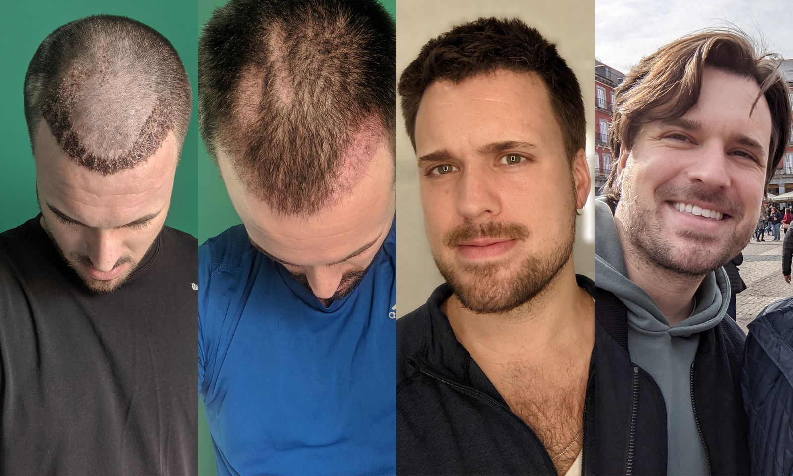 Hair Replacement NYC for a Better You